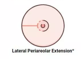 Ilustracja metody extended periareolar